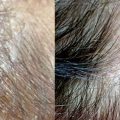 Problemele scalpului, ReHair, iBrows