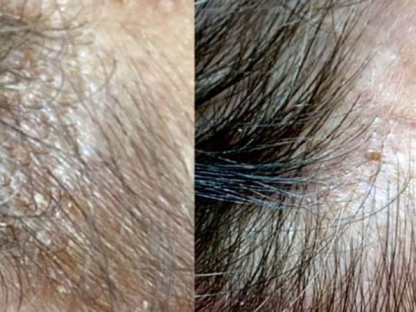 Problemele scalpului, ReHair, iBrows